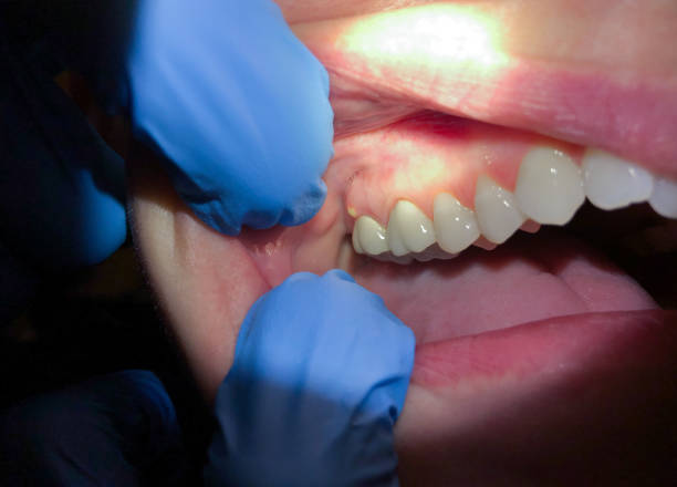Best Teeth Whitening  in Ridgeland, MS